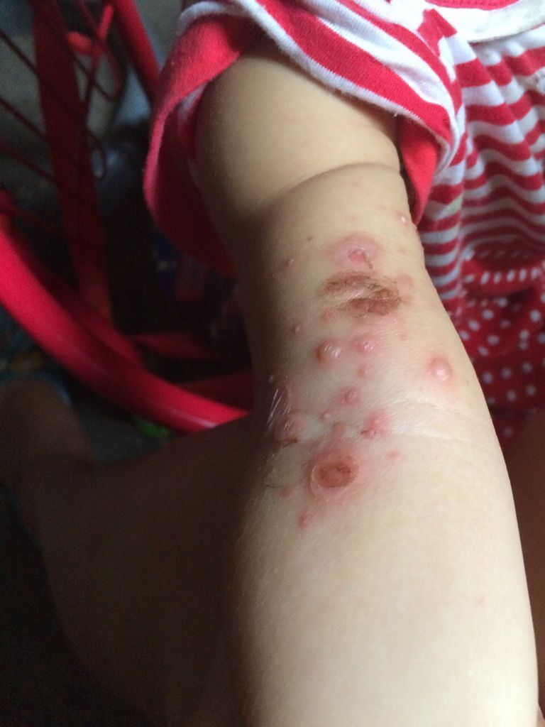 宝宝手臂上先是长小红点,然后变成小水泡接着变成大水泡,然后会破掉