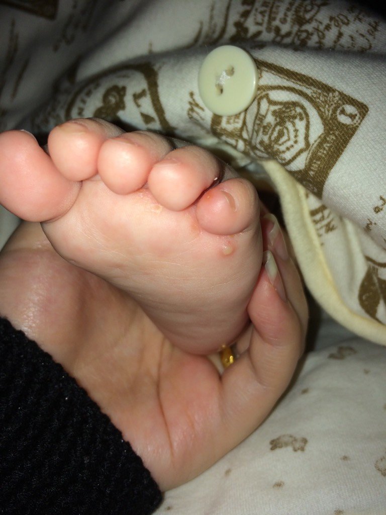 七个月左脚脚趾缝长泡,脚底也有小白泡,请问这是什么东西呀?影响大吗?