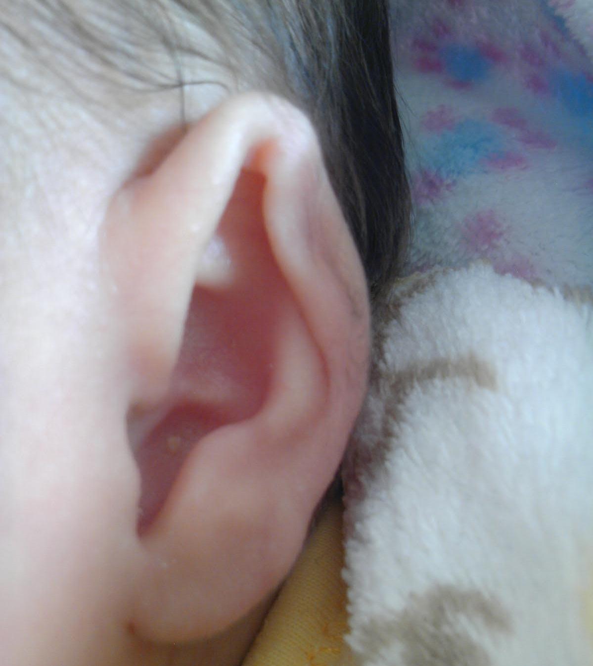 婴儿出生时一只耳朵上的软骨被压扁了,请问能怎么做?