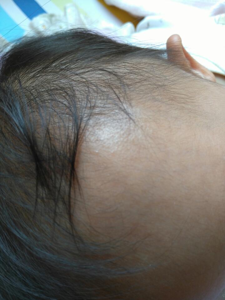 宝宝18个月,有和米粒似的痘痘一个月了,头上,前面