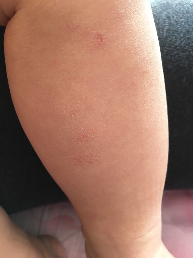 宝宝皮肤干,头部和身上有小疙瘩,打完育苗会多,腿上有时起红疙瘩过几