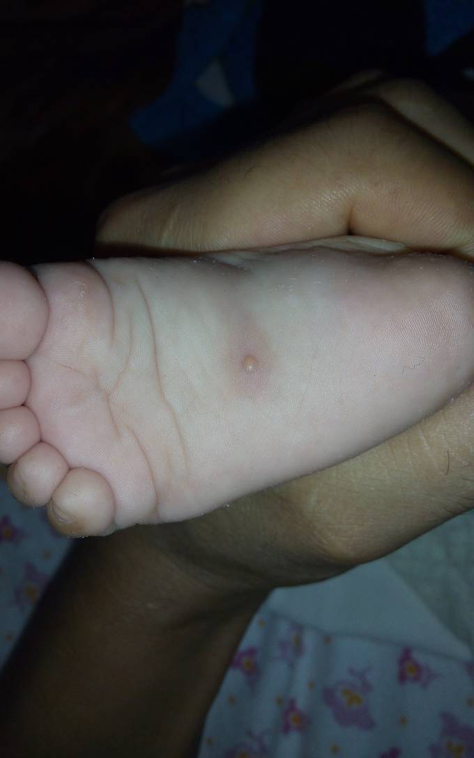 宝宝脚底湿疹图片