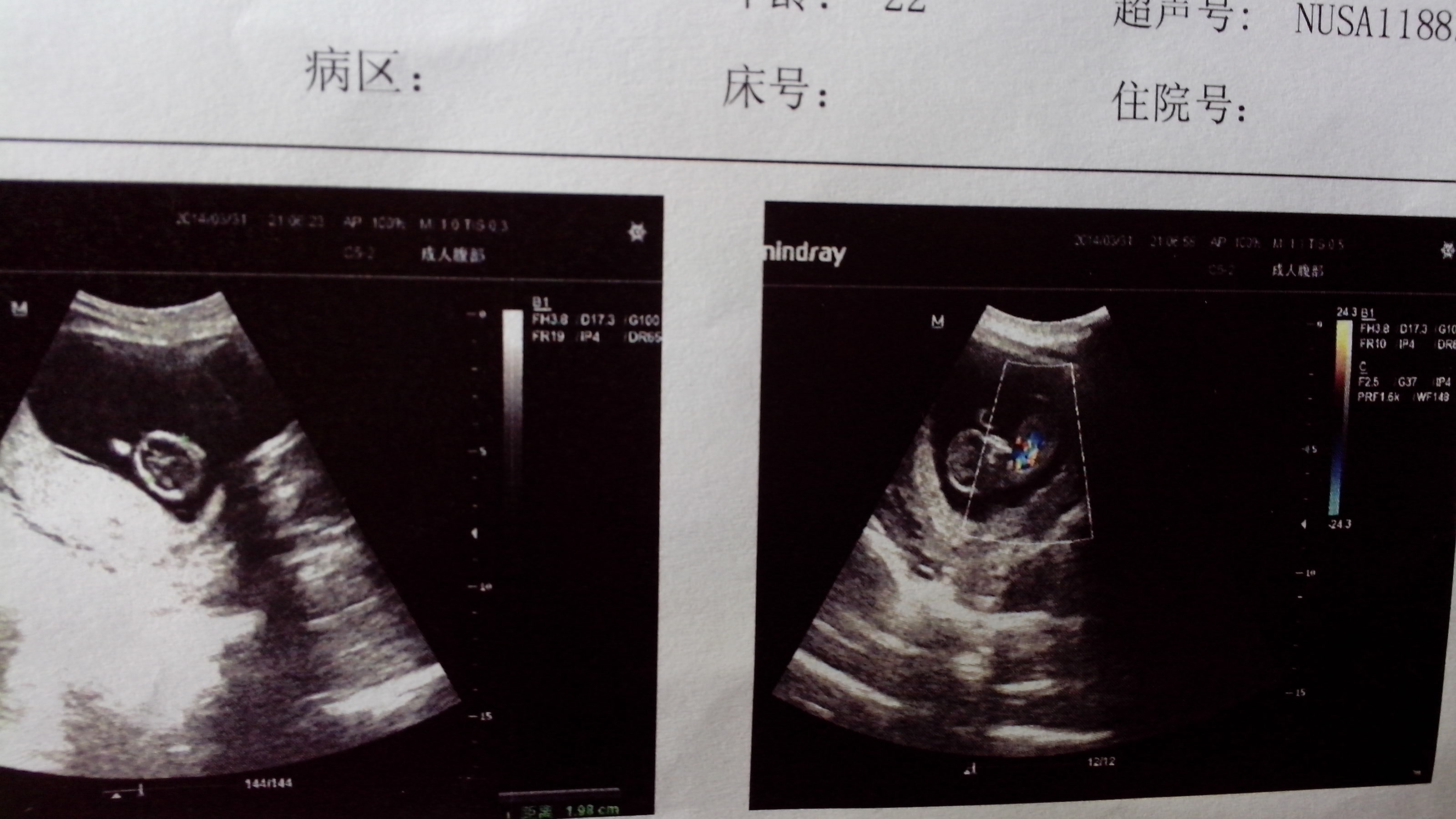 单胎孕囊图片图片