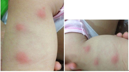 女 1岁 浙江 嘉兴 病情描述(发病时间,主要症状等):13个月宝宝胳膊,腿