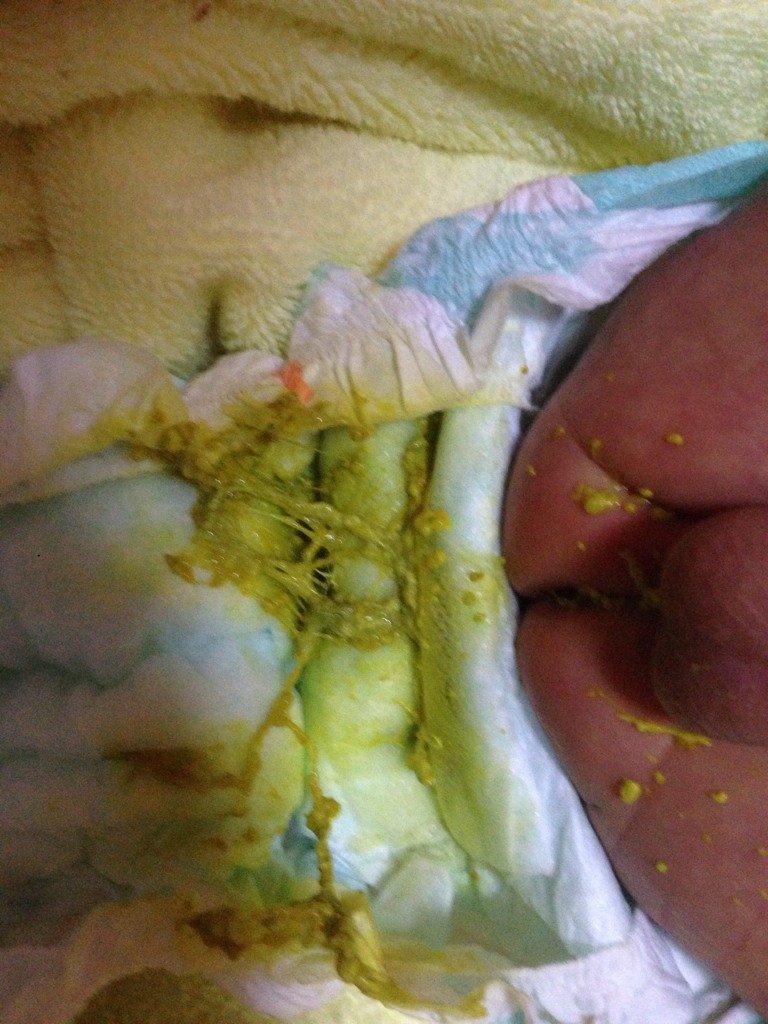 新生儿13天大便不正常,有点拉稀,且次数较多,一天6 7次,担心死了,这样