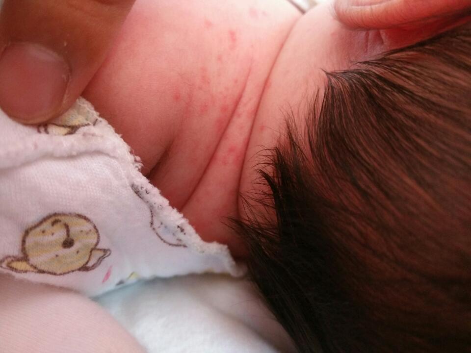 宝宝11天脖子左侧和后面是不是湿疹,怎么处理,能触摸吗?会不会痒