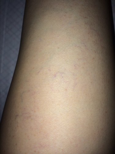 请问大腿侧面紫色血管怎么回事?