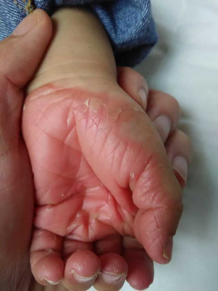 3岁宝宝手脚蜕皮非常严重,无法控制,怎么办?