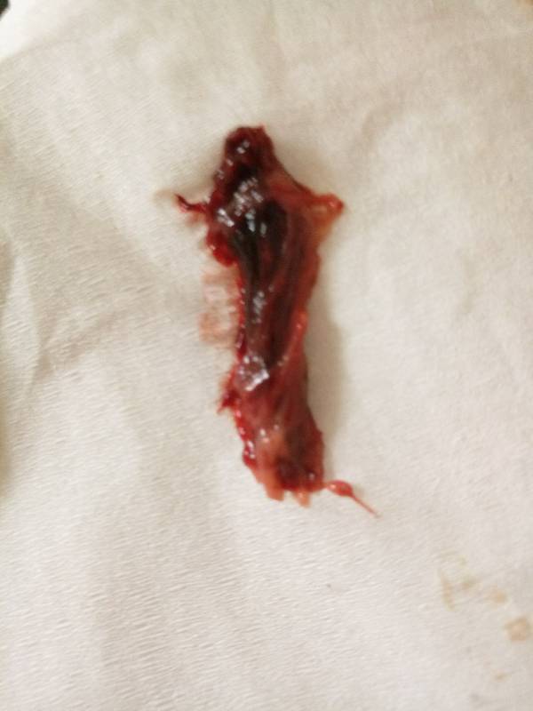 药流后排出的东西,请问是孕囊吗有图慎入