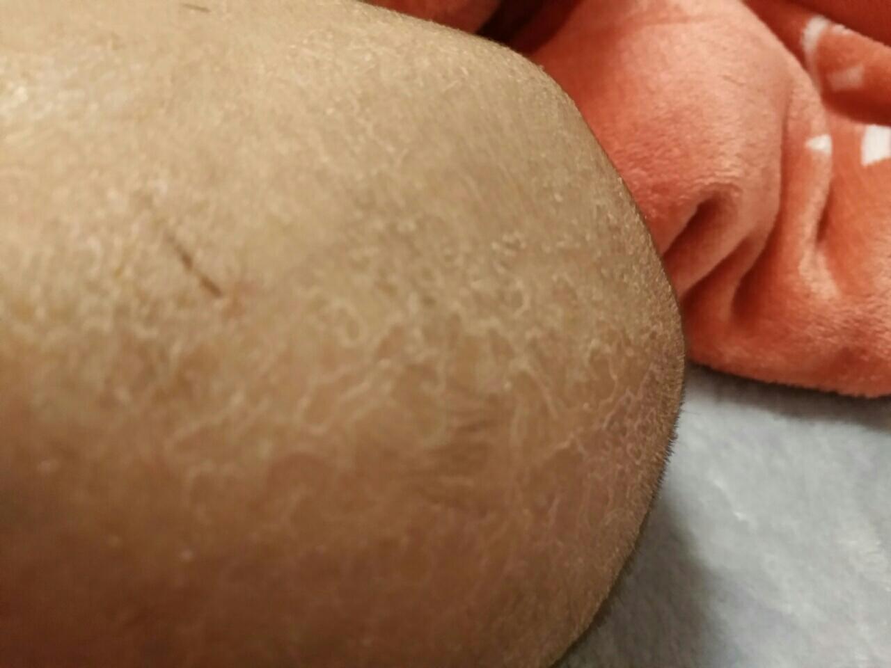 宝宝头上有干皮皮怎么办
