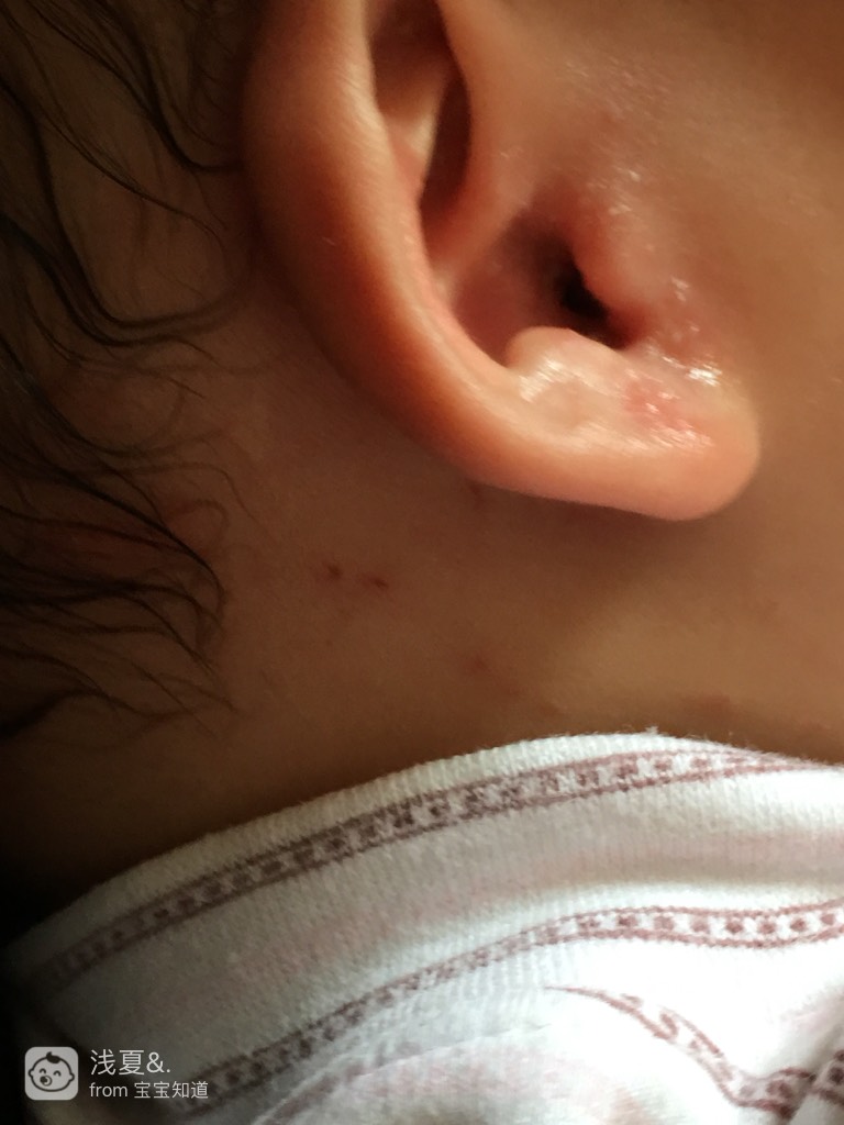 我家宝宝昨天耳朵一直流黄水出来,今天耳朵红红的,上面还伴有一粒粒的