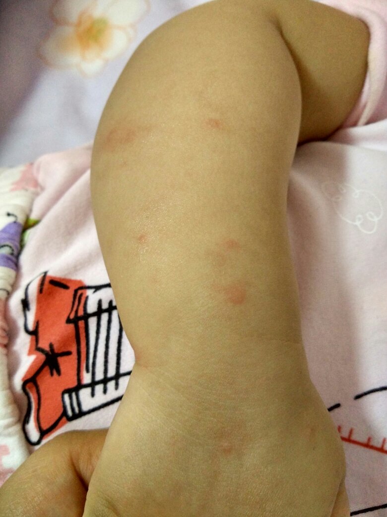 过敏吗?是什么原因?10个月宝宝,晚上洗澡发现的,是不是跟季节有关?