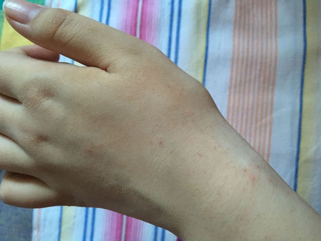 坐月子期间,午觉睡醒左手手背突然起了一层小疙瘩,不碰就不痒,请问这