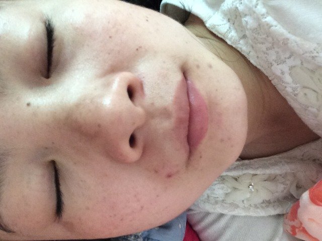 怀孕13周,鼻子上长斑,会好么?求方法