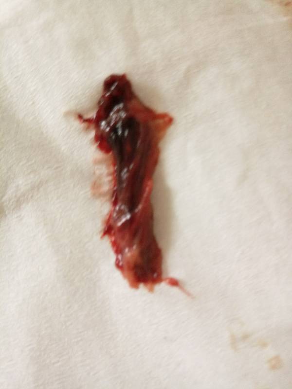 药流后排出的东西,请问是孕囊吗有图慎入