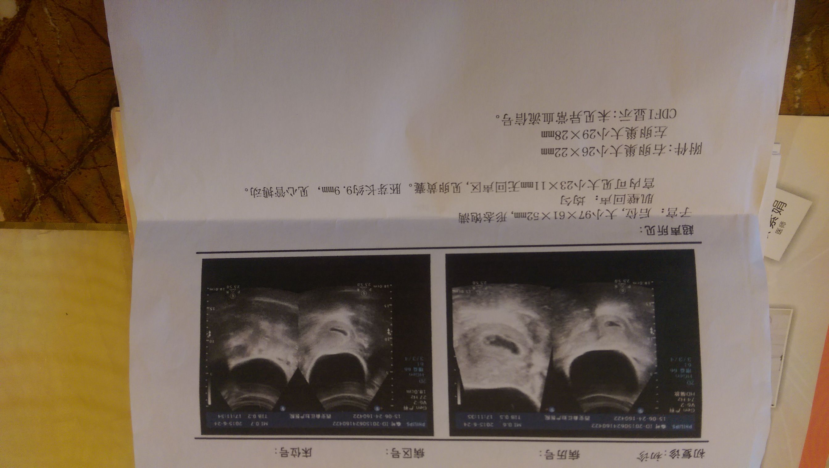 茄子形状孕囊图片图片