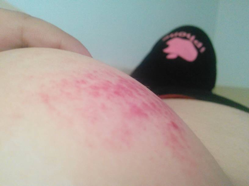 刚才乳房有点痒 我就去挠 然后就看见这样了 怎么回事?