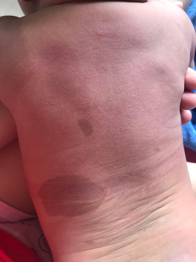 咖啡斑神经纤维瘤宝宝