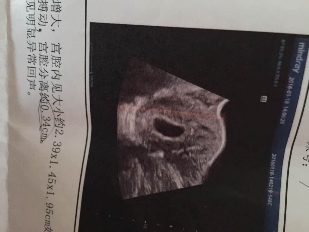 怀孕50天彩超图图片