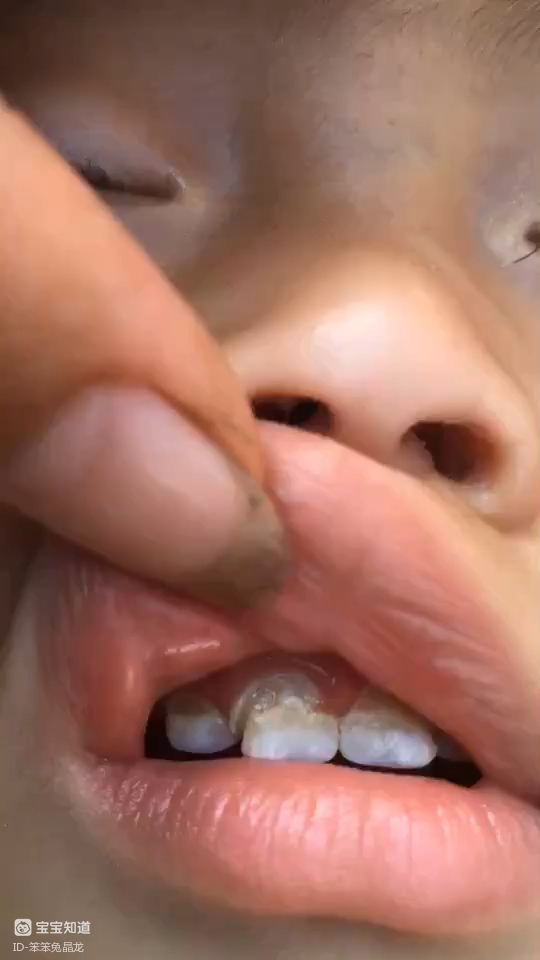 宝贝一岁三个月,牙齿发黄坑坑洼洼的,不知道有什么好方法能让牙齿变好