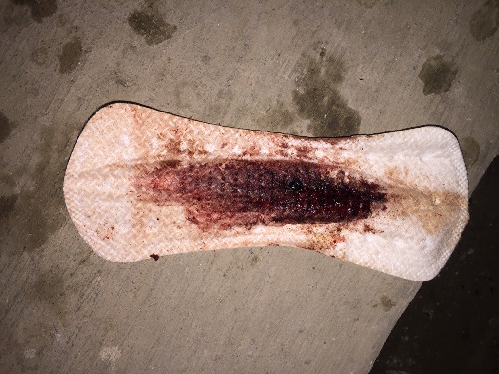 我刨腹产两个多月了,这两天下面有红的,请问这是恶露吗