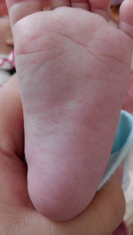宝宝四个月手脚起红疹!别的地方没有