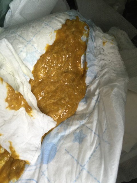 宝宝最近大便蛋花样,而且尿少,吃奶到最后总是左右使劲摇头!