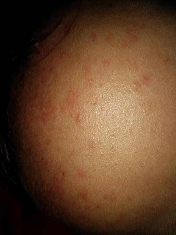 宝宝一周岁大了额头部位长的很多像痱子样的红红点,亲戚家也有个这么