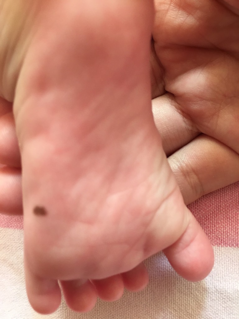 4岁宝宝黑色素瘤图片