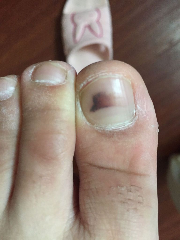 断奶第11天(月经还没来)最近左腹部偶尔隐痛 脚大拇指趾甲出现黑褐色