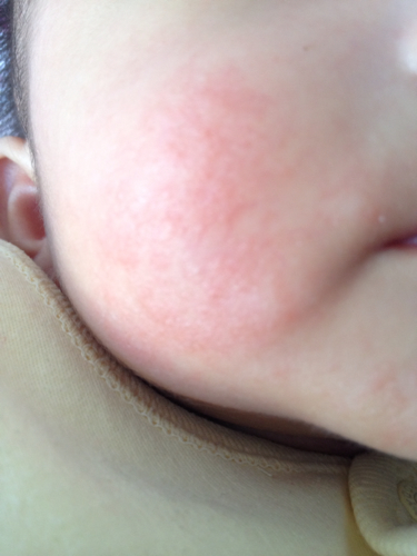 宝宝脸上红痘痘图片图片