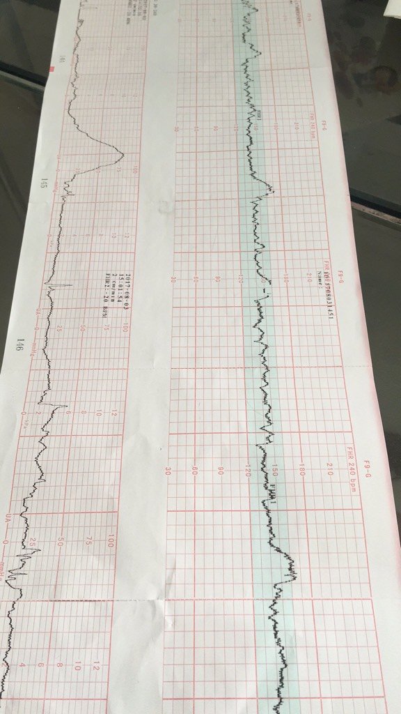 5楼 我一共到现在做了三次胎心监护,每次都有宫缩,医生也没说啥啊