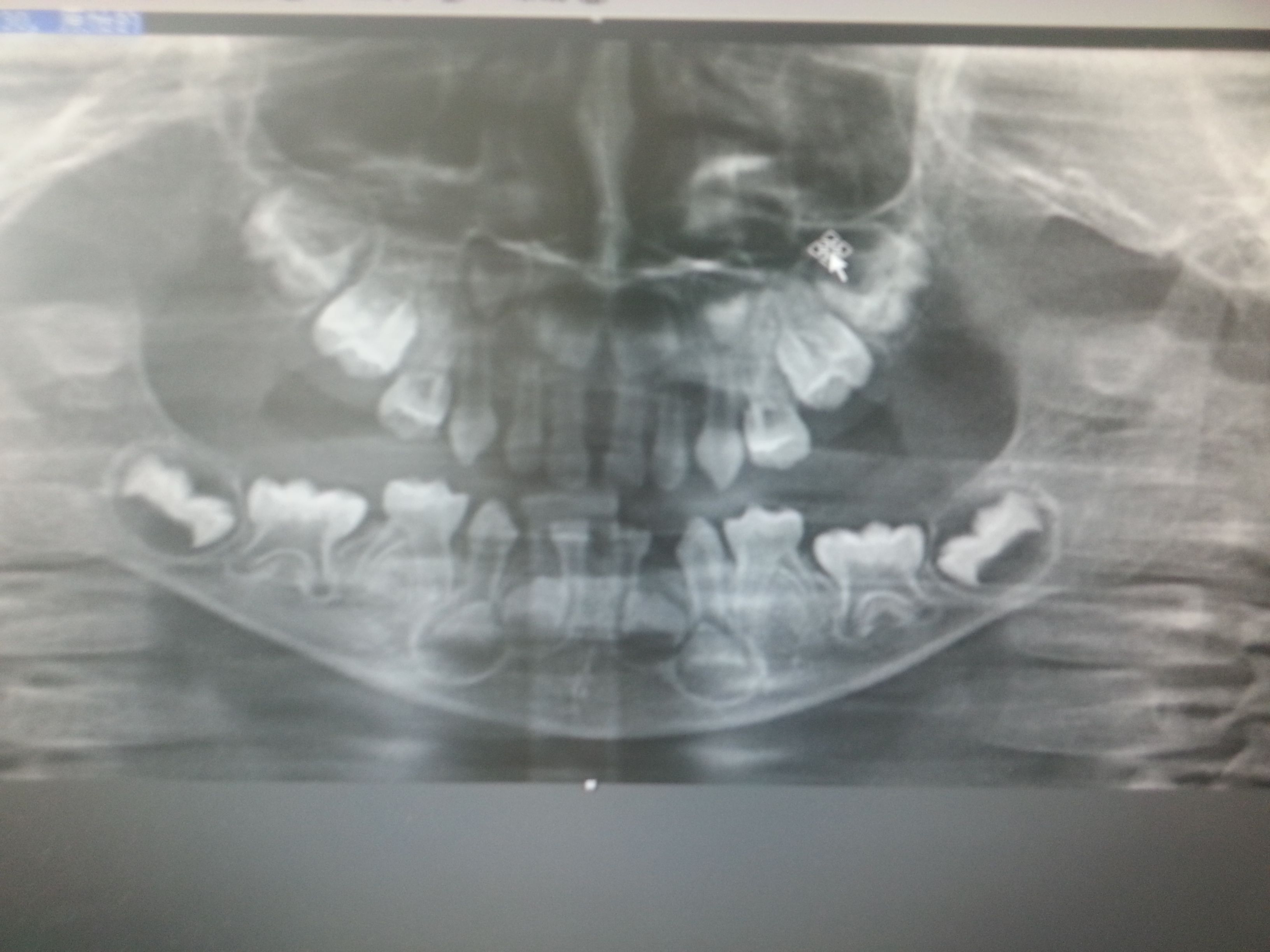 多牙症x光图片