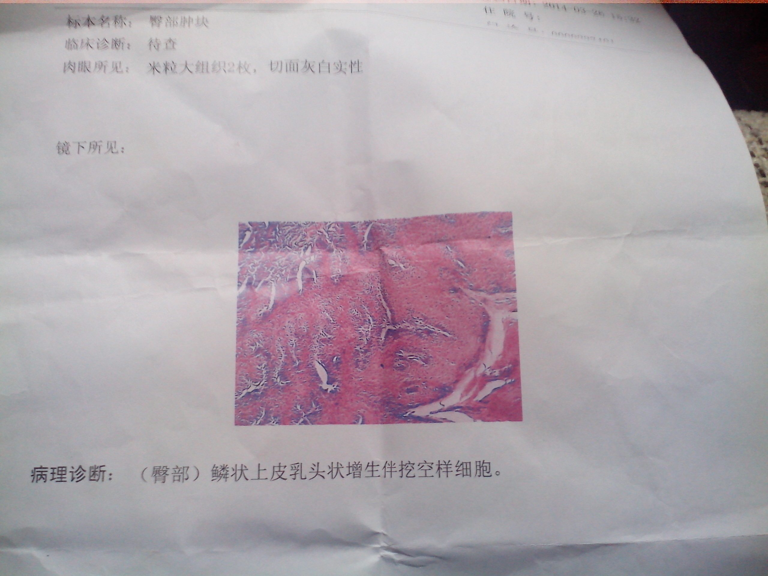 鳞状上皮乳头状增长伴有挖空细胞