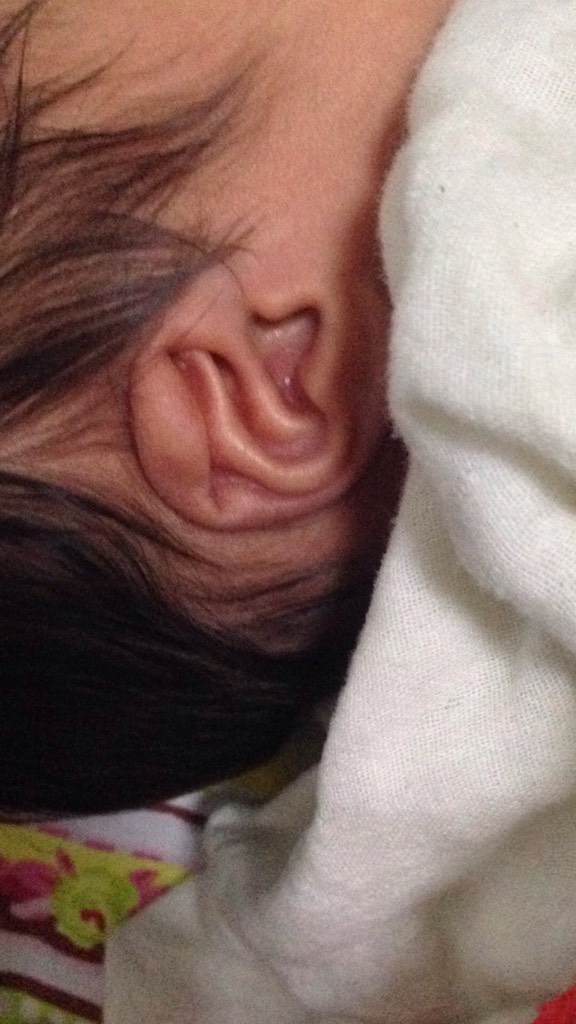 宝宝耳朵没有对耳轮图片