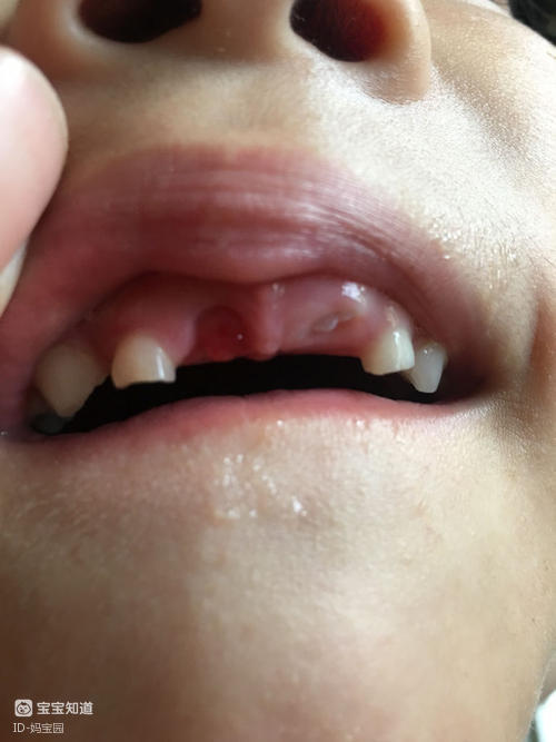 我家宝宝把两颗门牙磕掉了我要怎样告诉她她才不会因为没有门牙而自卑