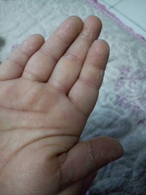 三岁小孩手指头脱皮,怎么回事前俩天过敏了起来一堆小疙瘩,现在小疙瘩
