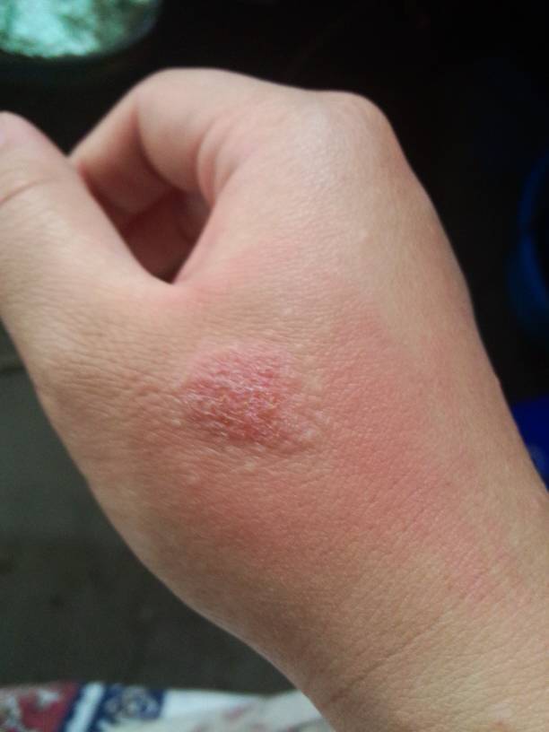 都抓脱皮了!痒还不能摸膏药!手面上也有!