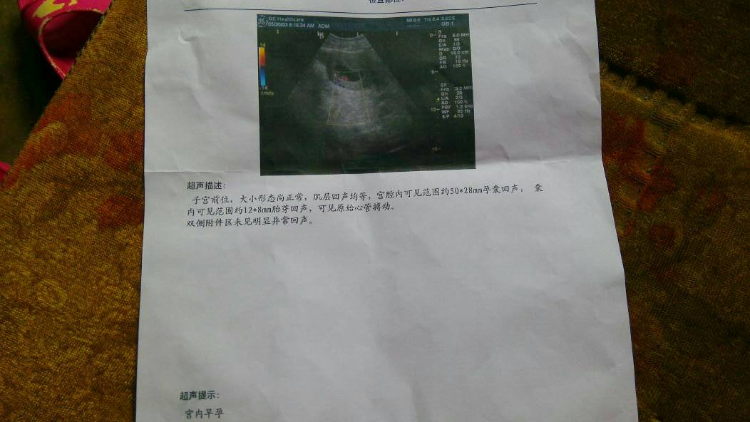 请问做b超,为什么只写宫内早孕,怎么不写宫内活胎啊?