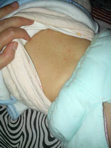 其他回答 你好,这多是小儿湿疹,是由于孩子对蛋白质过敏引起的,婴儿