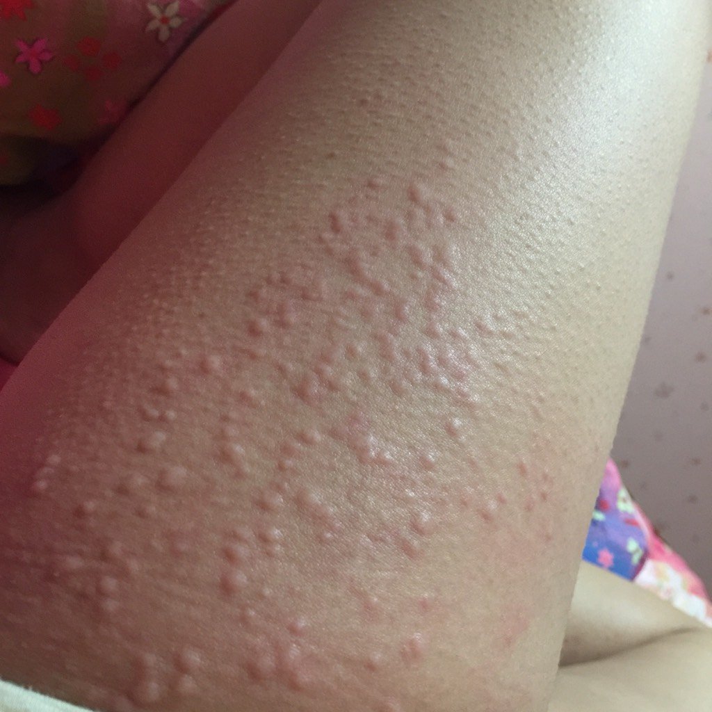 孕35周身上出了小疙瘩,很痒,特别是晚上,不知道是为什么,现在出的越来