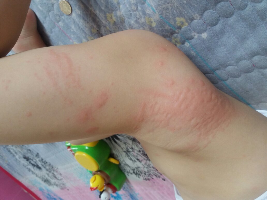 宝宝得了过敏荨麻疹?怎么办?有没有好的办法,可以治疗的快点!很着急!