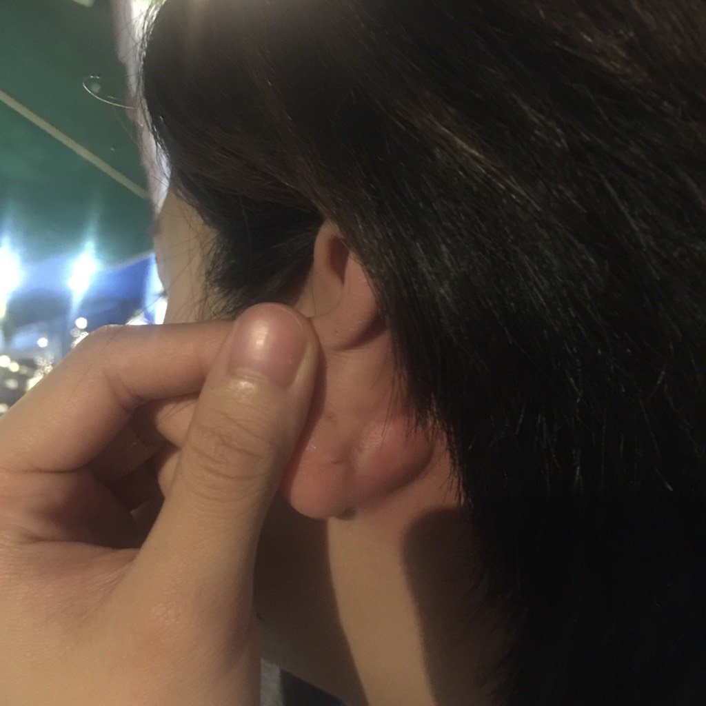 孕妈耳朵后面长了软包,超级无敌痛,怎么解决