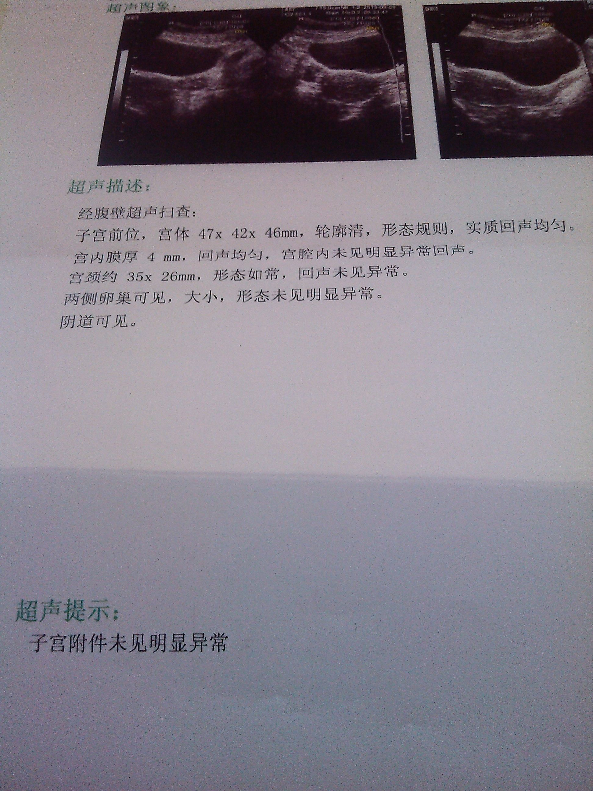 早孕超声报告图片