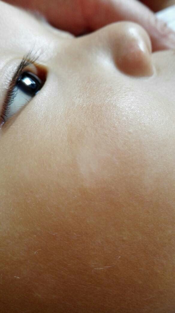 点,涂了婴宝后红点消失,成了一个白点,到医院检查大便 - 百度宝宝知道