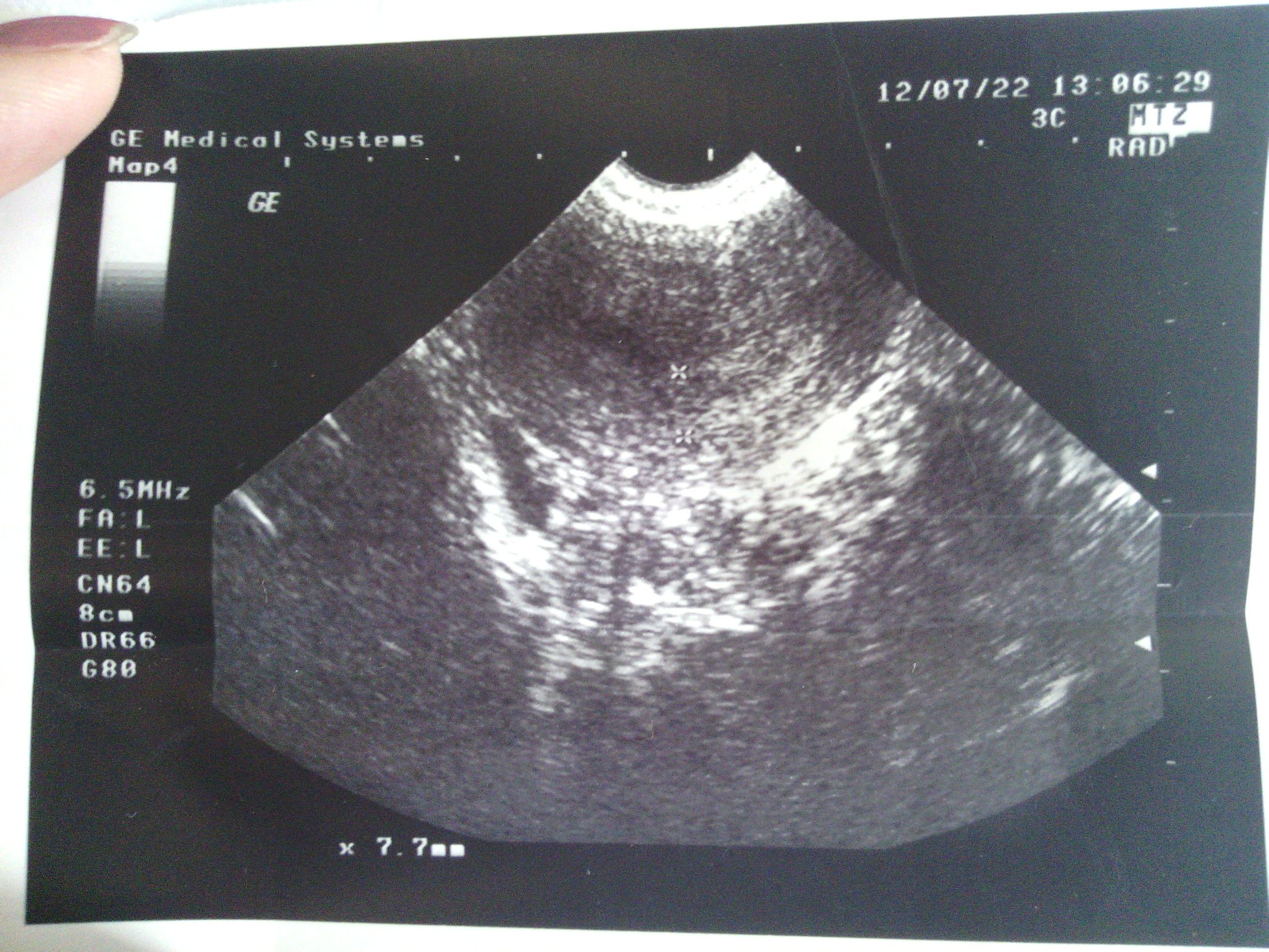 这是怀孕19周的B超单子，看图能看出男女吗？图上的三个亮点是什么？ - 百度宝宝知道