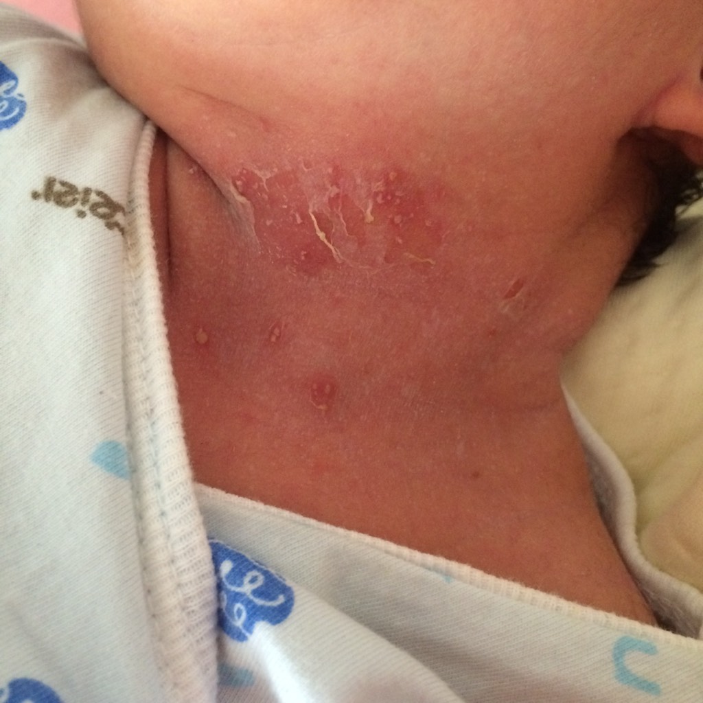 新生儿脖子起红疹子图片