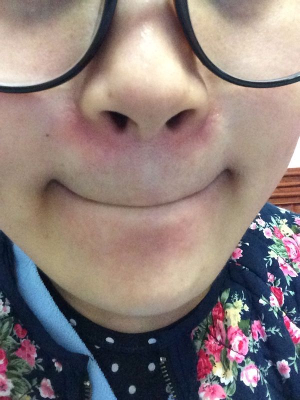 两侧鼻翼沟发红发痒一年 孕四月鼻沟发出小颗粒丘疹又痒又疼,检查有