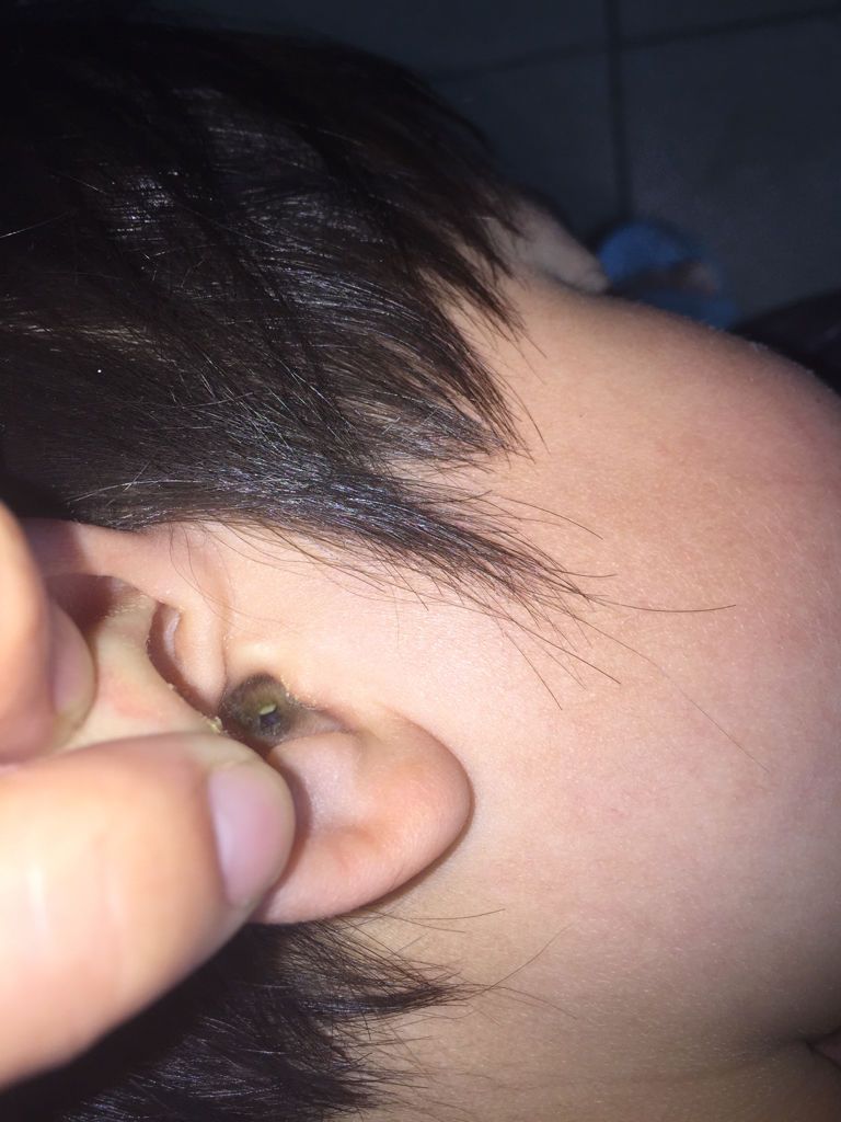 宝宝耳朵湿乎乎老说疼用手电照是有水还粘的,是中耳炎吗?