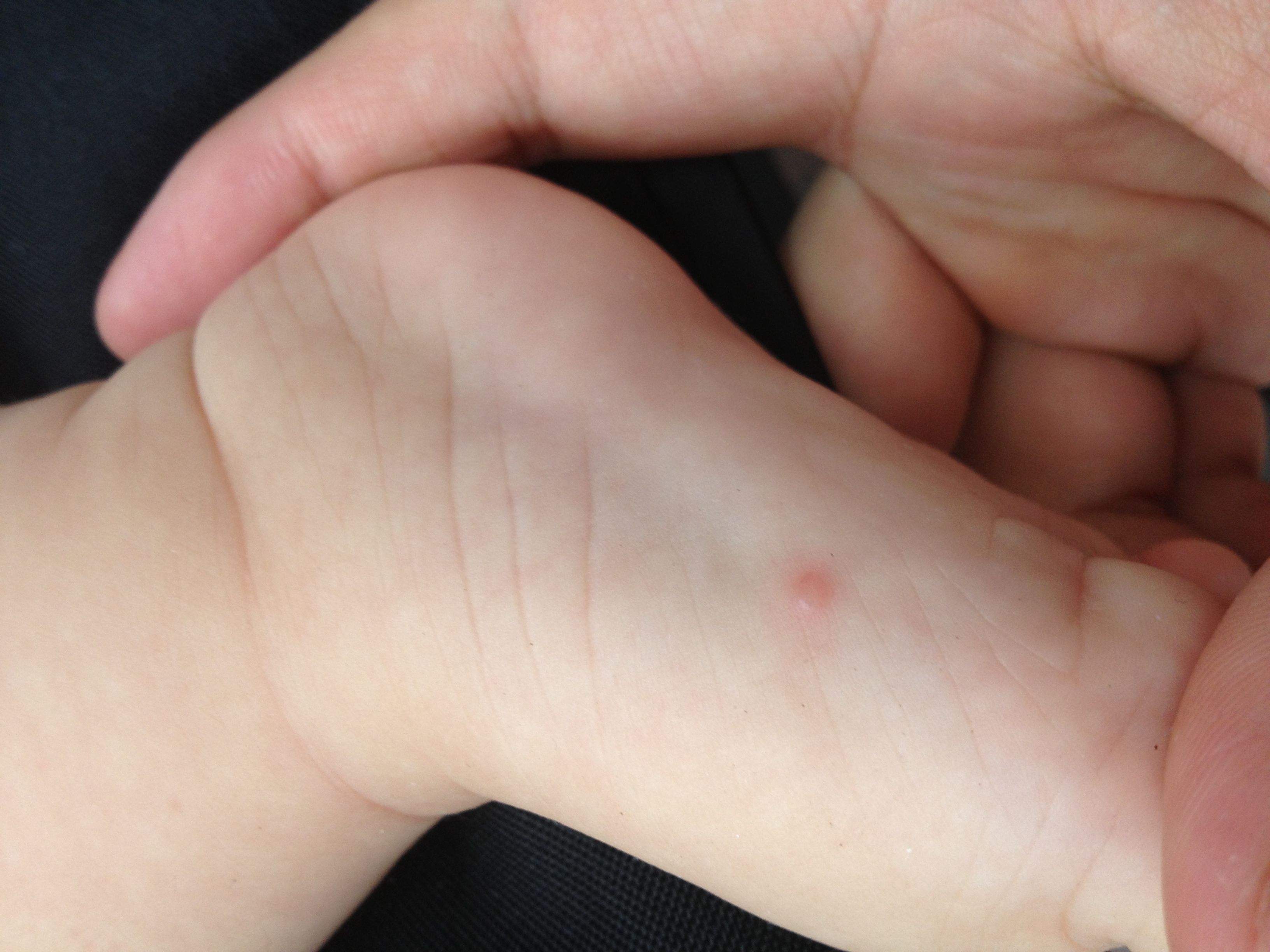 6个月宝宝脚上起了两个水泡样的小包,请帮忙看看是手足口么?